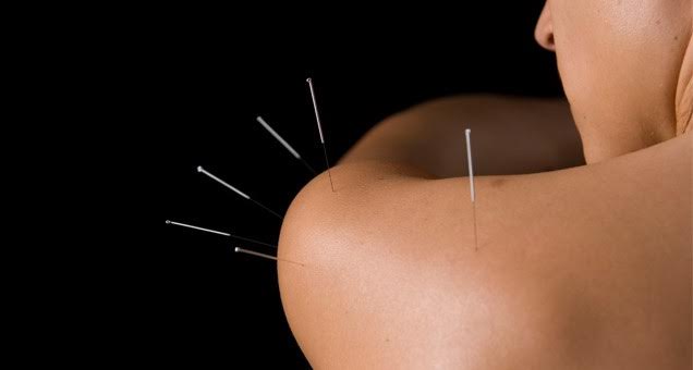 dry-needling-and-acupuncture
